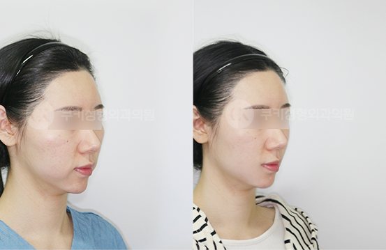 전후사진 광대축소 심부볼제거 4개월 — 45도 BEFORE·AFTER 4M