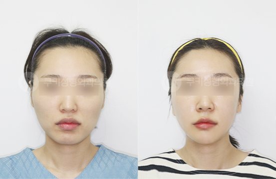 전후사진 광대축소 사각턱축소 턱끝축소 3개월 — 정면 BEFORE·AFTER 3M
