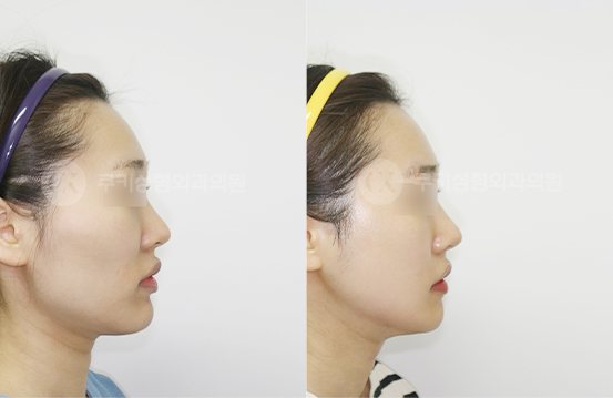 전후사진 광대축소 사각턱축소 턱끝축소 3개월 — 측면 BEFORE·AFTER 3M