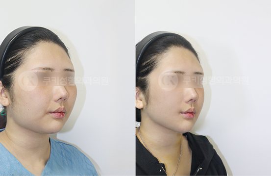 전후사진 광대축소 사각턱축소 양볼,이중턱흡입 5개월 — 45도 BEFORE·AFTER 5M
