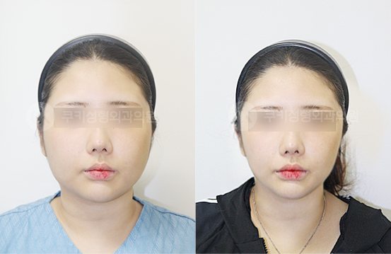 전후사진 광대축소 사각턱축소 양볼,이중턱흡입 5개월 — 정면 BEFORE·AFTER 5M