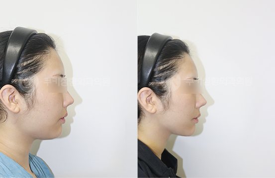 전후사진 광대축소 사각턱축소 양볼,이중턱흡입 5개월 — 측면 BEFORE·AFTER 5M