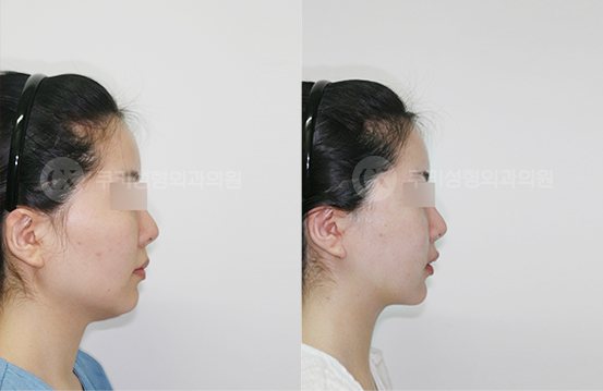 전후사진 광대축소 사각턱축소 양볼,이중턱흡입 심부볼제거 3개월 — 측면 BEFORE·AFTER 3M