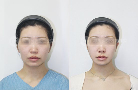 전후사진 광대축소 사각턱축소 5개월 — 정면 BEFORE·AFTER 5M