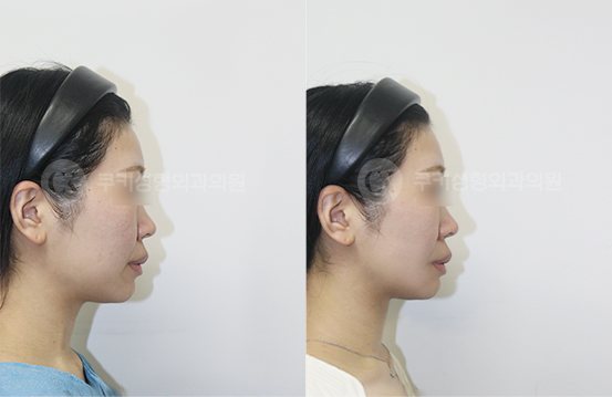 전후사진 광대축소 사각턱축소 5개월 — 측면 BEFORE·AFTER 5M