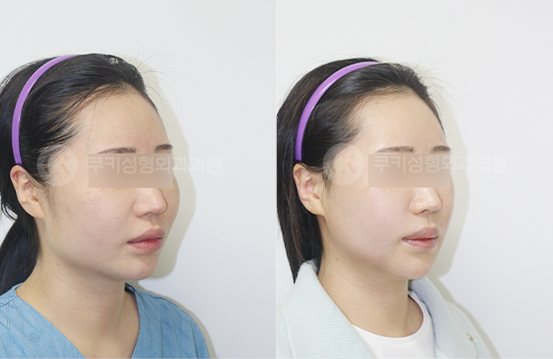 전후사진 광대축소 사각턱축소 3개월 — 45도 BEFORE·AFTER 3M