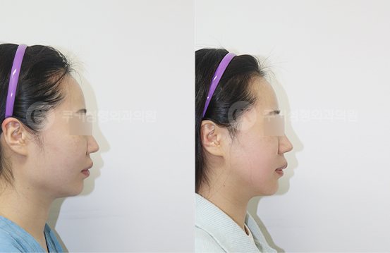 전후사진 광대축소 사각턱축소 3개월 — 측면 BEFORE·AFTER 3M