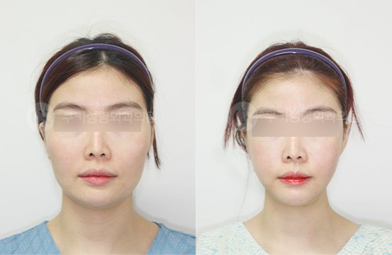 전후사진 광대축소 브이라인 3개월 — 정면 BEFORE·AFTER 3M