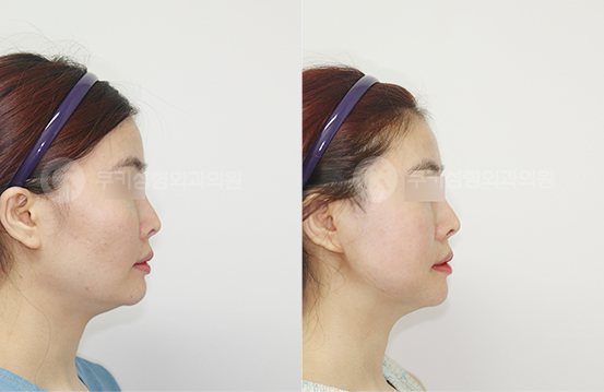 전후사진 광대축소 브이라인 3개월 — 측면 BEFORE·AFTER 3M