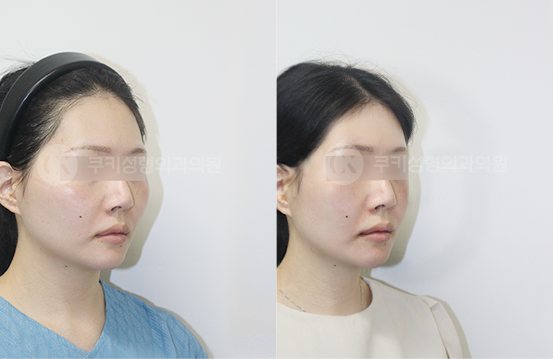 전후사진 광대축소 4개월 — 45도 BEFORE·AFTER 4M