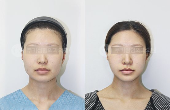 전후사진 광대축소 사각턱축소 4개월 — 정면 BEFORE·AFTER 4M