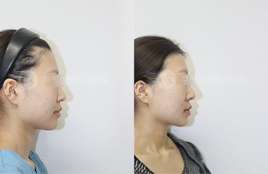 전후사진 광대축소 사각턱축소 4개월 — 측면 BEFORE·AFTER 4M