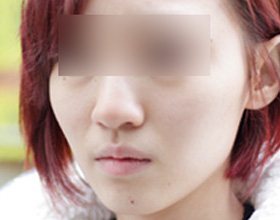 CASE02 옆광대 돌출된 경우 — 정면 얼굴 사진(눈 가림)