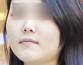 CASE03 45도 광대가 발달된 경우 — 45도 얼굴 사진(눈 가림)