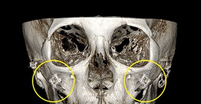 3D-CT 정면 — 수술 후(광대 고정 부위 노란 원)