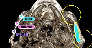 3D-CT 아래에서 본 모습(3D 광대축소술) — 수술 후, 앞광대·45도 광대·옆광대 표시