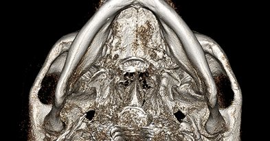 3D-CT 아래에서 본 모습(광대뼈 최후방 절골술) — 수술 전