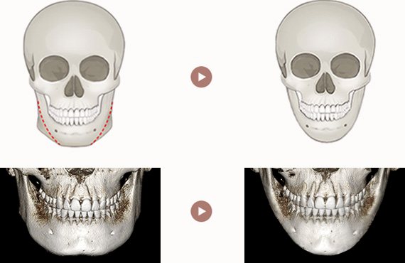 긴곡선 하악골 절제술 — 정면 두개골 그림(절제선 점선)과 3D-CT, 수술 전 → 후