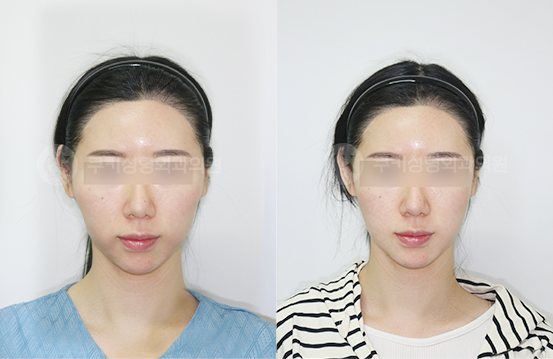 광대축소 심부볼제거 4개월 — 정면 BEFORE · AFTER