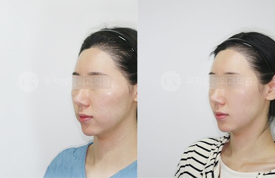 광대축소 심부볼제거 4개월 — 측면 BEFORE · AFTER