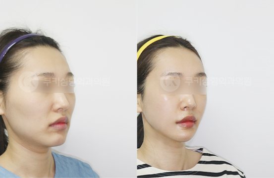 광대축소 사각턱축소 턱끝축소 3개월 — 45도 BEFORE · AFTER