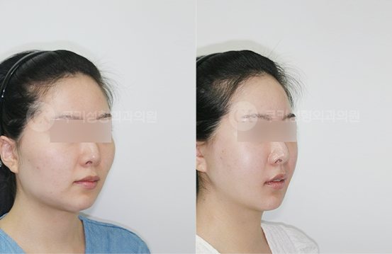 광대축소 사각턱축소 양볼,이중턱흡입 심부볼제거 3개월 — 45도 BEFORE · AFTER