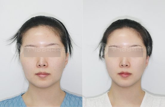 광대축소 사각턱축소 양볼,이중턱흡입 심부볼제거 3개월 — 정면 BEFORE · AFTER