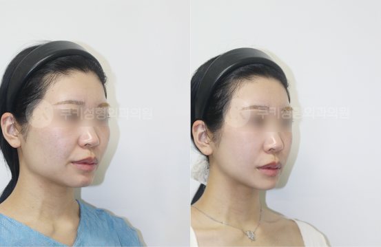 광대축소 사각턱축소 5개월 — 45도 BEFORE · AFTER