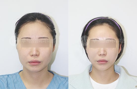 광대축소 사각턱축소 3개월 — 정면 BEFORE · AFTER