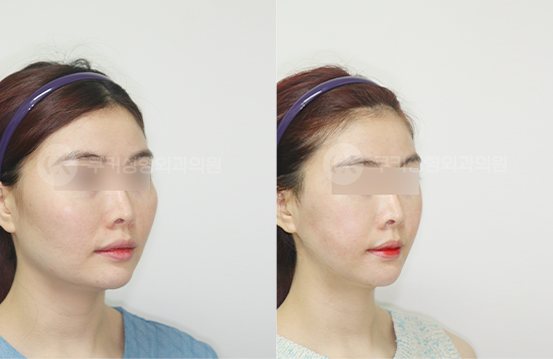 광대축소 브이라인 3개월 — 45도 BEFORE · AFTER