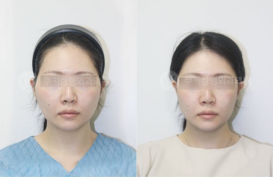 광대축소 4개월 — 정면 BEFORE · AFTER