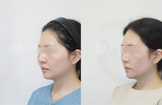 광대축소 4개월 — 측면 BEFORE · AFTER