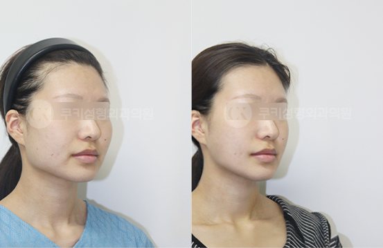 광대축소 사각턱축소 4개월 — 45도 BEFORE · AFTER