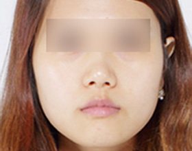 CASE01 얼굴 전체가 넓은 경우 — 정면 얼굴 사진(눈 가림)