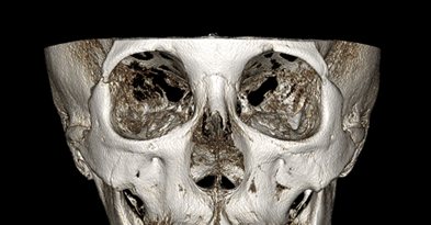 3D-CT 정면 — 수술 전