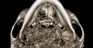3D-CT 아래에서 본 모습(3D 광대축소술) — 수술 전