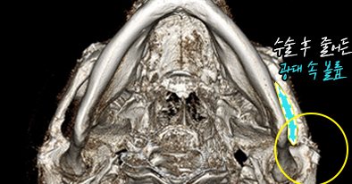 3D-CT 아래에서 본 모습(광대뼈 최후방 절골술) — 수술 후, 줄어든 광대 속 볼륨 표시