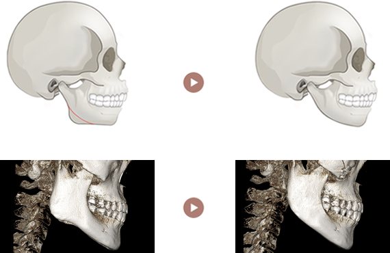 하악각 축소술 — 옆모습 두개골 그림과 3D-CT, 수술 전 → 후